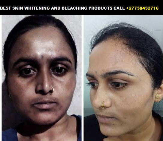 Permanent Skin Lightening+27738432716 Skin Whitening Pills Injection IN Pretoria Johannesburg Midrand Tembisa Soweto Cape Town Pietermaritzburg Durban Polokwane Witbank Bloemfontein Rustenburg