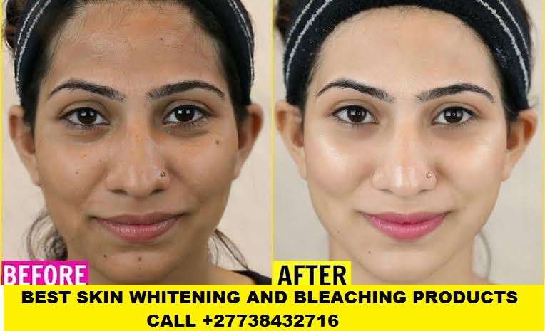 Permanent Skin Lightening+27738432716 Skin Whitening Pills Injection IN Pretoria Johannesburg Midrand Tembisa Soweto Cape Town Pietermaritzburg Durban Polokwane Witbank Bloemfontein Rustenburg