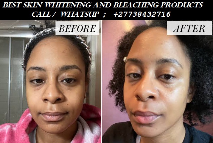 Permanent Skin Lightening+27738432716 Skin Whitening Pills Injection IN Pretoria Johannesburg Midrand Tembisa Soweto Cape Town Pietermaritzburg Durban Polokwane Witbank Bloemfontein Rustenburg